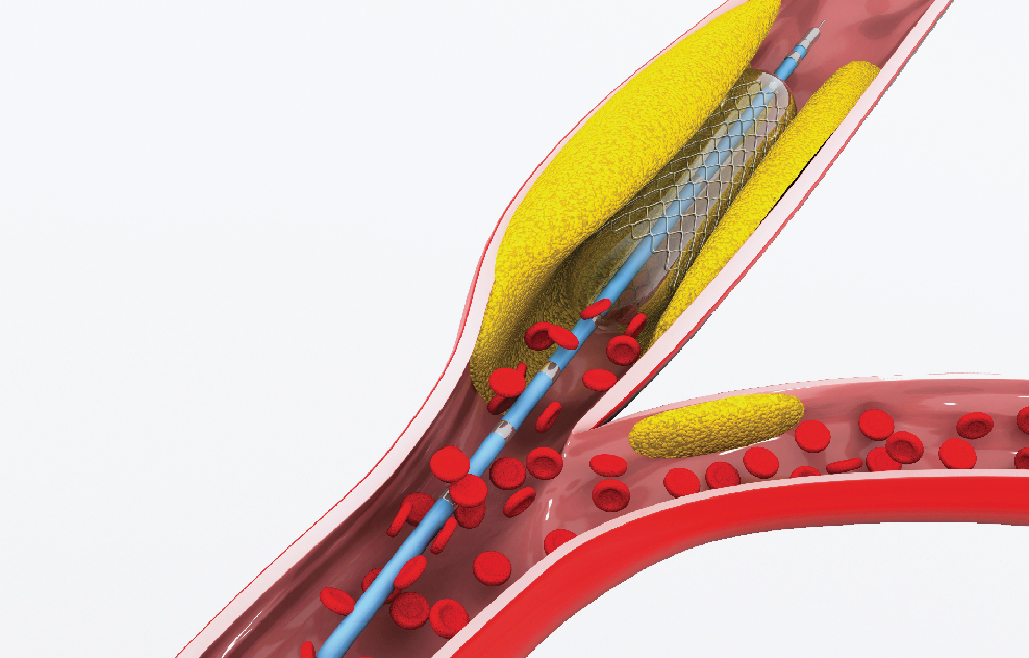 Balloon angioplasty to treat coronary artery disease conveniently and safely without surgery